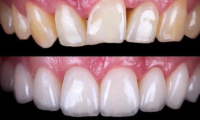 porcelain veneers teeth