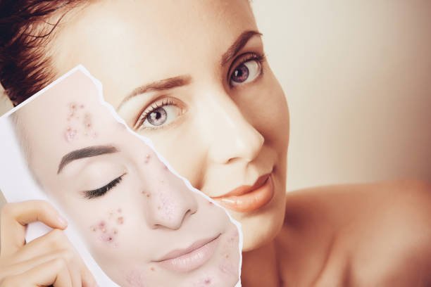 chemical peels for acne